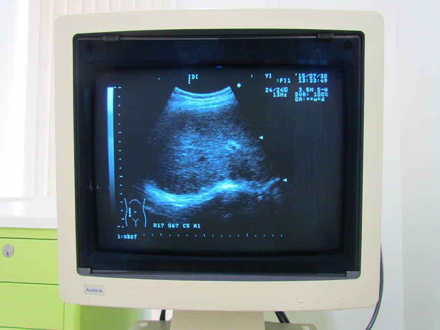 腹部エコー（Abdominal Ultrasound）