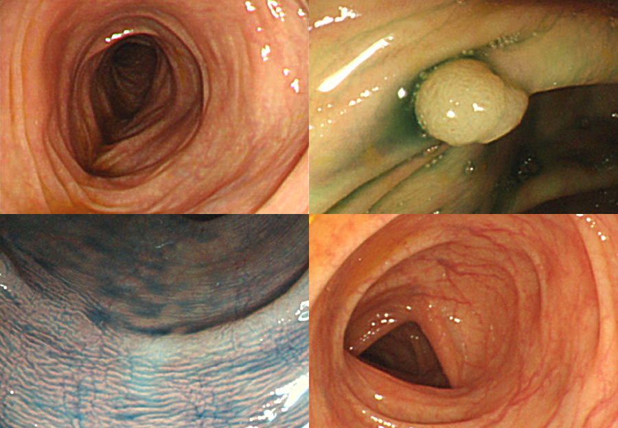 大腸内視鏡（Colonoscopy）